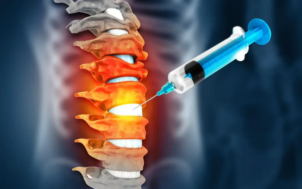 Illustration of a syringe reaching one level of the spine