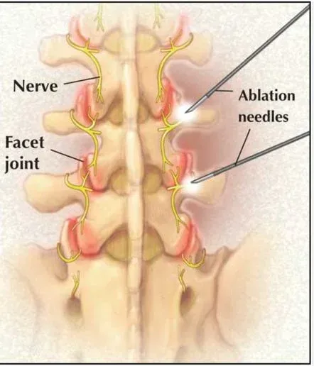 Labelled illustration of the facet joints of the spine